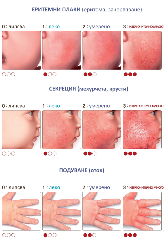 Какво е атопичен дерматит?