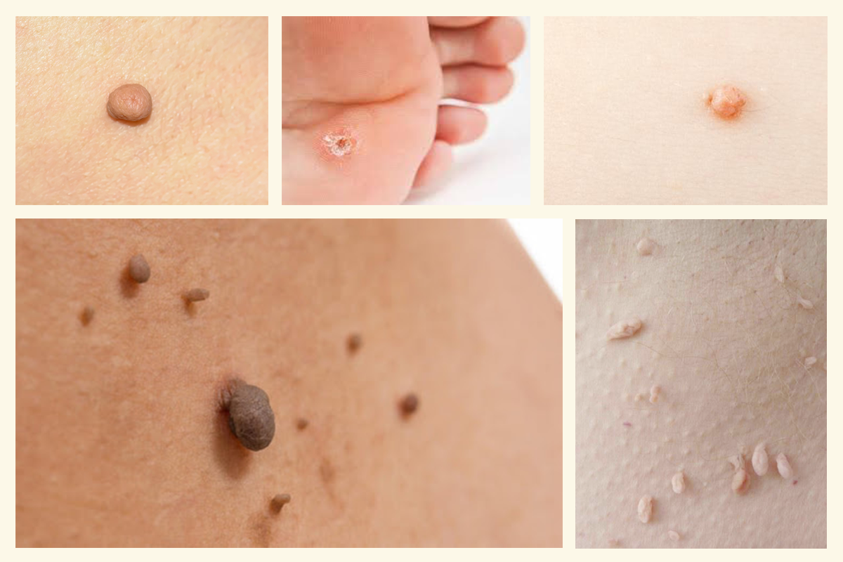 Образувания, които могат да се премахнат чрез електрокоагулация