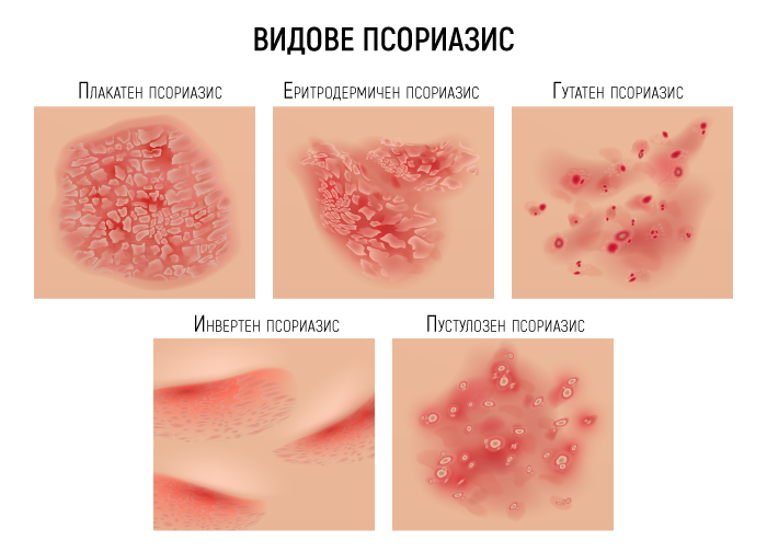 Заболяването има разновидности: