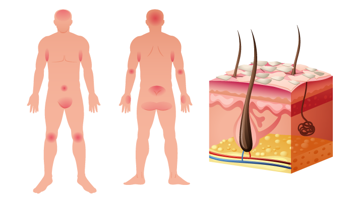 Кое е най-щадящото лечение на псориазиса и какъв е пътят на пациента?