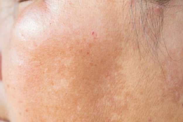 Какво е хиперпигментация?