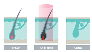 Ефективна ли е лазерната епилация с Elysion-PRO?