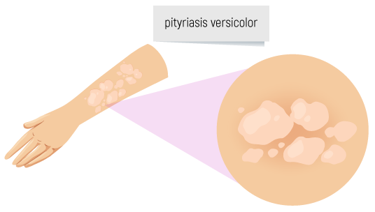 Pityriasis versicolor