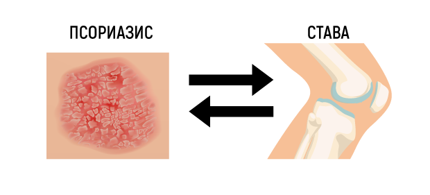 Каква е връзката между псориазиса и ставите? Защо част от пациентите развиват псориатичен артрит?