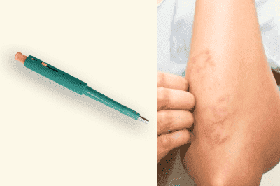 Кожна биопсия с пънч