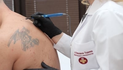 Премахване на фиброми, брадавици и кокоши тръни