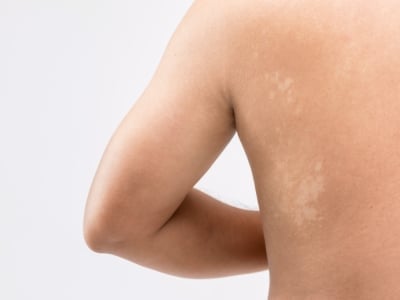 Разноцветен лишей (Питириазис верзиколор)