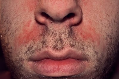 Себореен дерматит и себорея