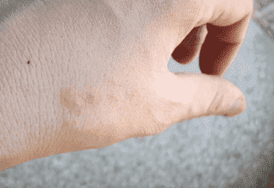 Ухапвания от насекоми