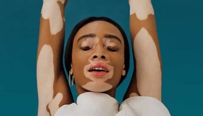 25-ти юни ден на витилиго - за първи път в България с участието на д-р Виолина Тодева