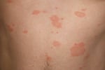 Розов лишей (Pityriasis rosea)